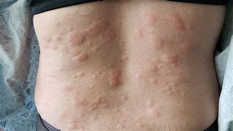 7 Surprising Triggers of Chronic Hives | Everyday Health