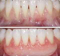 How Long Does a Gum Graft Last? | Anderson Periodontal Wellness