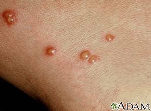 Chiggers Bites Look Like