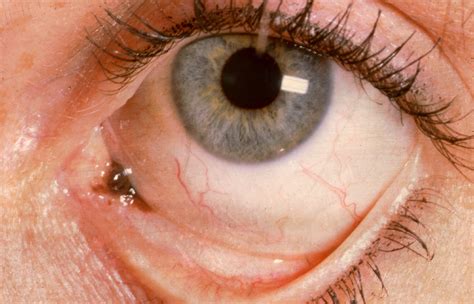 Early Conjunctival Melanoma