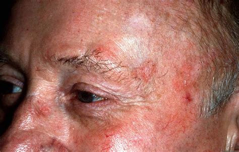 Seborrheic Keratosis - Causes, Symptoms, Home Treatment