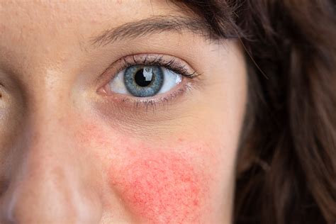 Understanding Rosacea: Symptoms, Causes, and Treatment Options ...