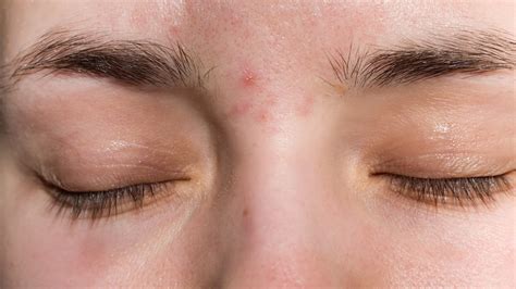 What's Causing Acne Between Your Eyebrows And How Do You Get Rid Of It ...