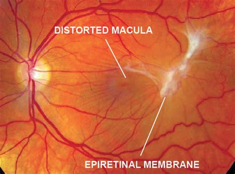 Epiretinal Membrane (Macular Pucker) - Retina Specialists of Michigan