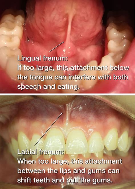 Frenectomy