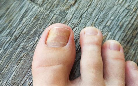 Top 19 get rid of fungus on toenail 2022