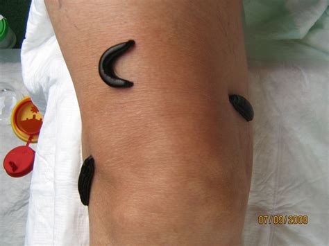 Leeches on knee- alternative therapy for arthrosis - DocCheck