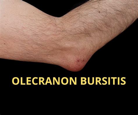 OLECRANON BURSITIS TREATMENT | London Elbow Surgeon