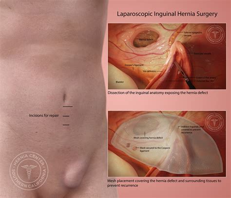 Inguinal Hernia Repair Los Angeles Pasadena Orange County CA