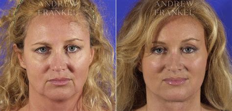 Facial Rejuvenation photos | Beverly Hills, CA. | Patient 11396