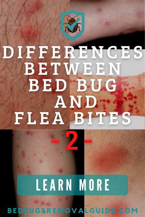 Differences Between Bed Bug and Flea Bites-2 | Bed bug bites, Bed bug ...