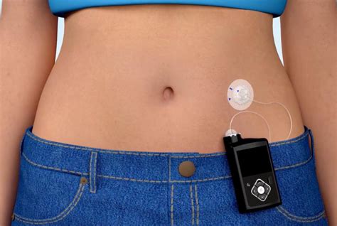 Medtronic Insulin Pump