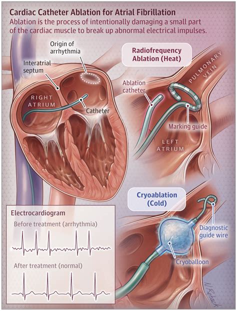 Cardiac catheter ablation for heart rhythm abnormalities – Artofit