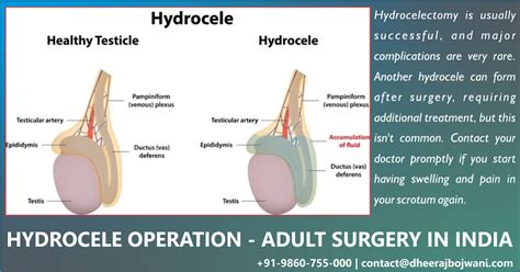 Hydrocele surgery in India - Get Better and More Wide-Ranging Care