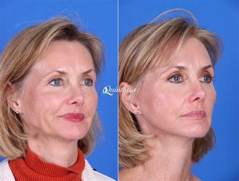 Minilift or Mini Facelift | Milwaukee & Madison | Quintessa