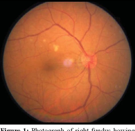 Figure 2 from Ocular ischemic syndrome; A case report. | Semantic Scholar