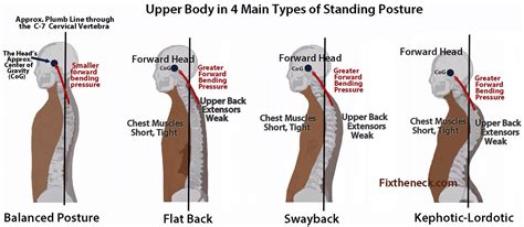 Kyphosis - Causes, Symptoms, Exercises, Surgery, Treatment