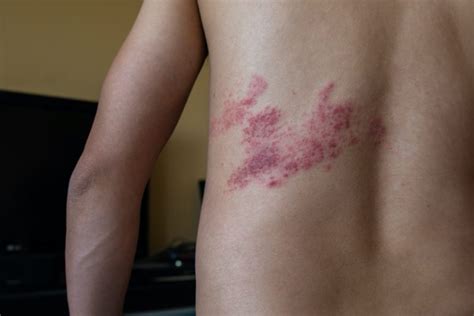 How Serious Can The Symptoms Of Shingles Be? - bilipro