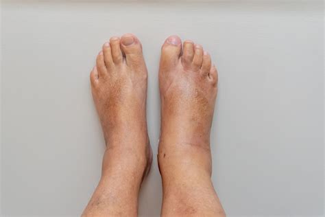 Left Foot Swollen On Top And Ankle Store | emergencydentistry.com