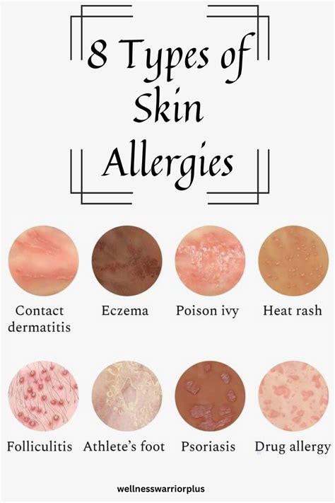 8 Types of Skin Allergies in 2024 | Skin allergies, Allergies, Skin rash