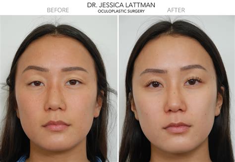 NYC Eyelid Asymmetry Case Study | New York Ptosis Surgeon Dr. Jessica ...