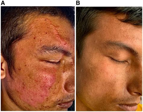 Facial Tuberculoid Leprosy in: The American Journal of Tropical ...