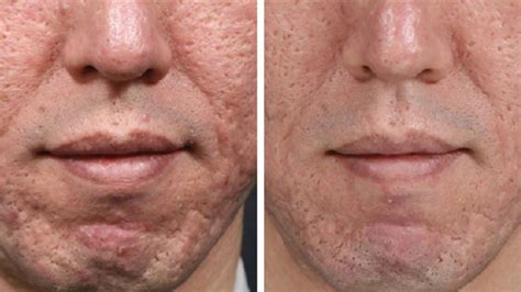 "Journey through Micro-Needling: Captivating Before and After ...