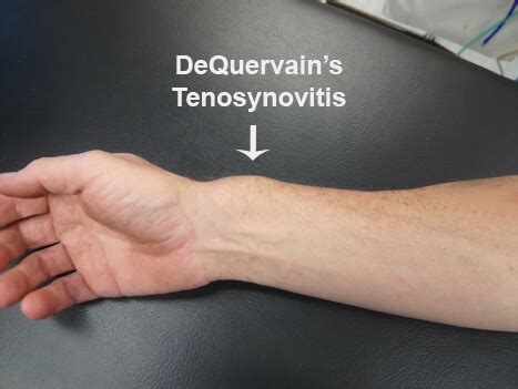 De Quervain's Tenosynovitis & Other Tendonopathies - Orthopaedic ...