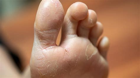 Tips for Managing Foot Psoriasis | Christ Memorial