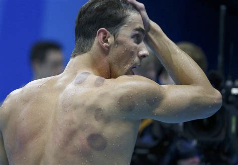 U.S. swimming star Phelps gives cupping a boost in China | The Japan Times