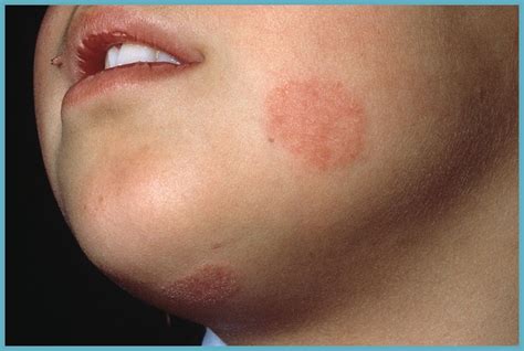 Fungal Rash On Skin