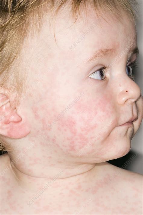 Measles rash - Stock Image - M210/0443 - Science Photo Library