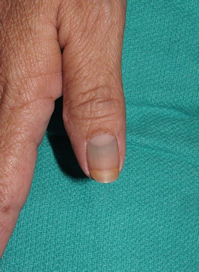 Nail discoloration | MDedge Family Medicine