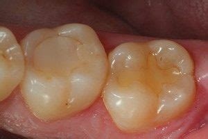 glass-ionomer-fillings | Muswell Hill Smile