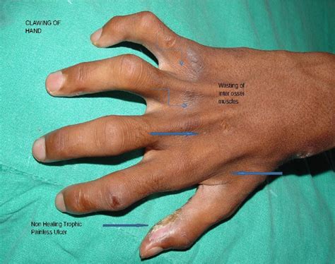 Tuberculoid Leprosy Symptoms