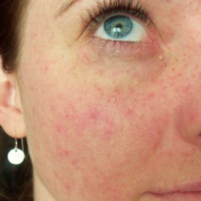 Red Dots Around Eyes: Causes, Treatment, and When to Worry