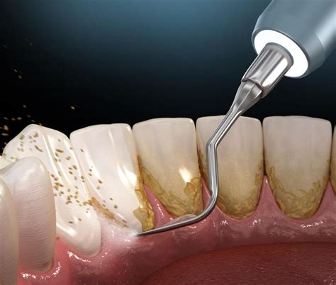 Dental Plaque: What You Need To Know: Jennifer H. Xie, DDS: Cosmetic ...