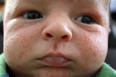 baby acne causes | BABY ACNE