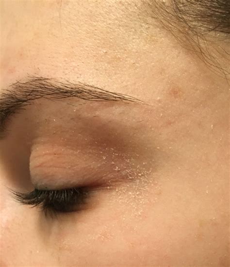 [misc] Recommendations for dry flaky skin around eyes : r/SkincareAddiction