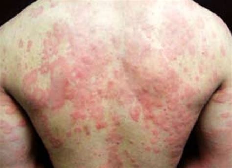 Imágenes sobre la Urticaria