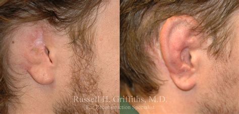 Case 2 - Ear Reconstruction from Cancer or Trauma - Before and After ...