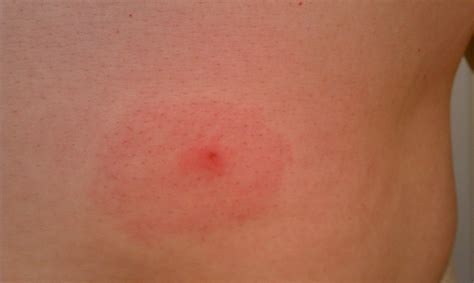 Spider Bite Bullseye Rash