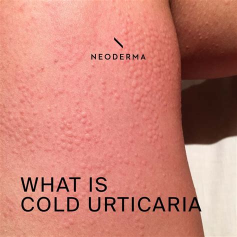 What is Cold Urticaria – NEODERMA