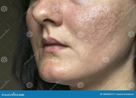 Acne Scars On The Face Royalty-Free Stock Photo | CartoonDealer.com ...