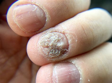 Nail Disorders | White Rock Dermatology