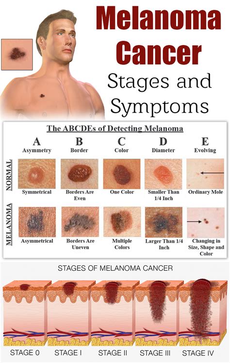 Signs Of Melanoma Skin Cancer