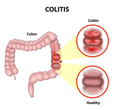 Ulcerative Colitis » Palmer General Surgeon | Mat-Su Surgical ...