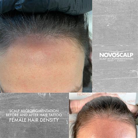 Scalp micropigmentation before and after female hairline tattoo sydney ...