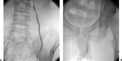 49 Variocele Embolization | Radiology Key