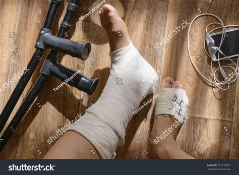 Broken Leg Cast Stock Photo (Edit Now) 715578019